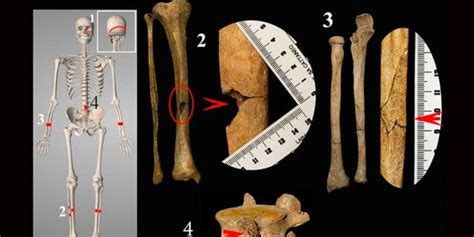 Medieval Skeleton Shows Visible Signs Of Decapitation And Execution