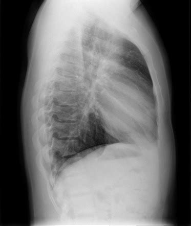 Chest Lateral View Radiology Reference Article Radiopaedia Org