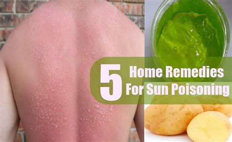 Top 5 Home Remedies For Sun Poisoning Natural Treatments And Cure For