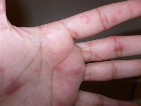Red Spots On Back Of Hands Pictures Photos