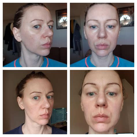 I Am 41 This Is Beforeafter Using Tretinoin 0025 Daily Since Jan 2020