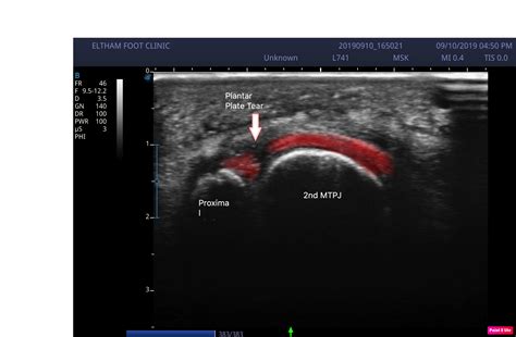 Plantar Plate Tear Edit Eltham Foot Clinic