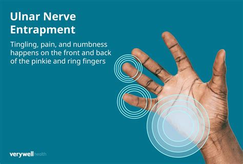 Ulnar Nerve Entrapment Symptoms Causes Treatment