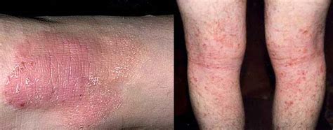 Neurodermite: sintomi, cause e trattamento