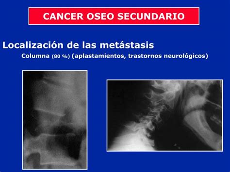 Imagine endoscopică a cancerului colorectal. PPT - Tumores Óseos de la Columna Vertebral PowerPoint ...