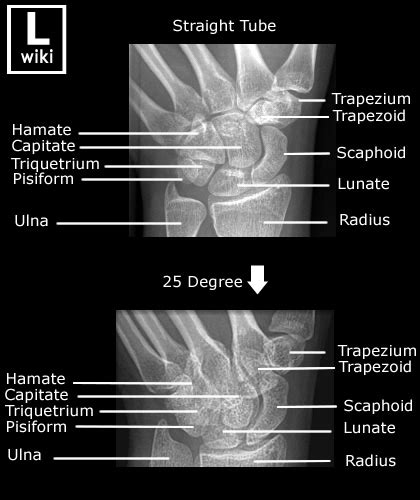 Scaphoid Radiographic Anatomy Wikiradiography