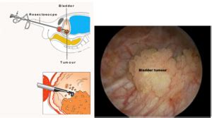 Transurethral Resection Of Bladder Tumour Turbt Chin Chong Min Urology Robotic Surgery Centre
