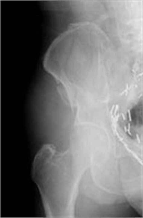 Duverney Fracture