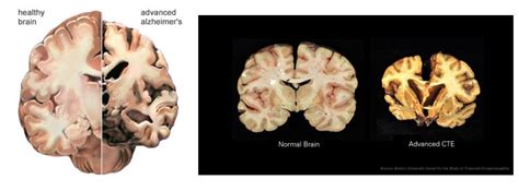 Understanding And Treating Traumatic Brain Injury And Chronic Traumatic