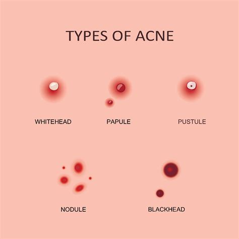 Acne Scars What Causes Them And 5 Ways To Treat Them And Tiege Hanley