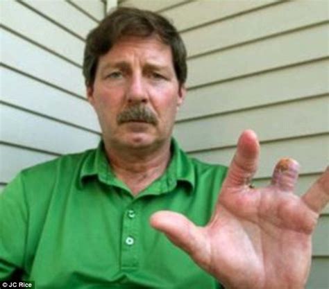 Edward Lunger Golfer Loses 2 Fingers As They Are Bitten Off By