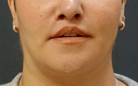 Beautiful Upper Lip Lifts Without Scars Dr Haworth
