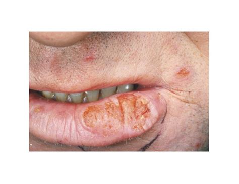 Ppt Cut In Corner Of Mouth Angular Chelitis Angular Cheilitis