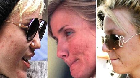 3 famosas que lucharon contra el acné y cómo se recuperaron marcela tauro