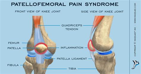 What Is Patellofemoral Pain Syndrome Mass4d® Foot Orthotics