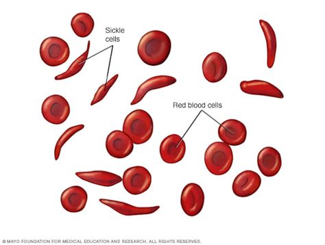 Sickle Cell Anemia Symptoms And Causes Mayo Clinic