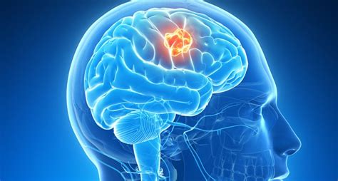 Brain Tumor Cancer Types And Treatment Options Healthcare In India