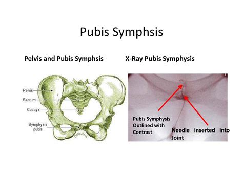 Pubic Symphysis Pain Stemcelldocs Weblog