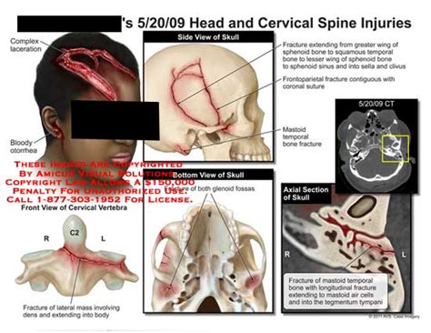 Amicus Illustration Of Amicus Injury Head Cervical Spine Injuries Laceration Bloody Otorrhea