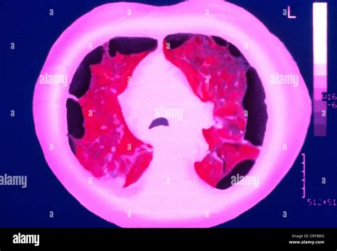 Bullous Emphysema Lung Scan Stock Photo Alamy