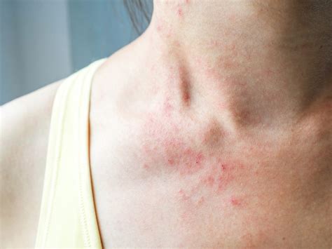 What Does Eczema Look Like Best Health Magazine