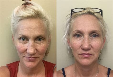 Danielle collins, tv's face yoga expert, believes we should all have the opportunity to look and feel the very best we can for our age and to care for our face, body, and mind using natural and holistic techniques. Danielle Collins Face Yoga Before And After ~ news word