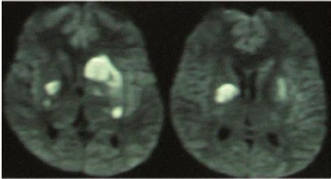 Diffusion Weighted Magnetic Resonance Images Showing Restriction In