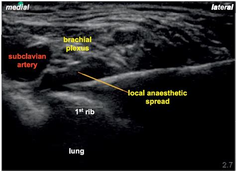 Ultrasound Guided Supraclavicular Brachial Plexus Block Wfsa Resources