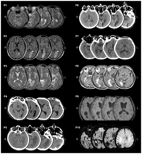 Axial Views Of Ctmri Scans Of The Patients L Left R Right