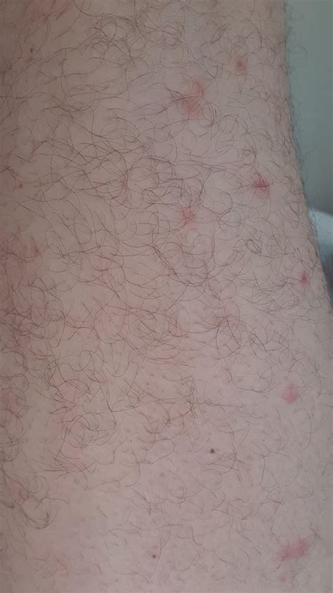 Rash On The Back Of Left Leg Anyone Any Idea What This Could Be