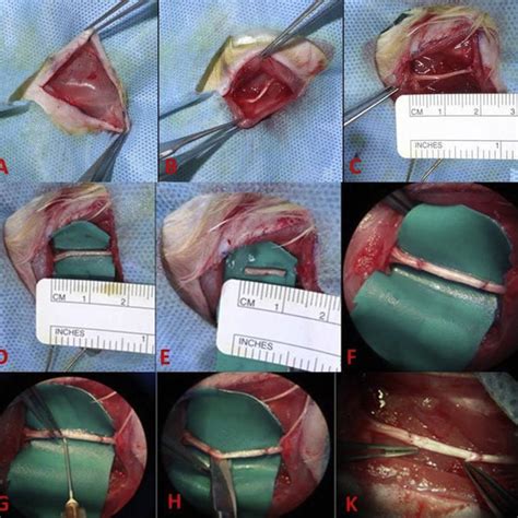 Sunderland classification of nerve injury has 5 degrees: Sunderland classification of nerve injury adapted from ...