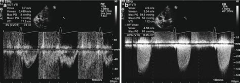 Echocardiographic Evaluation Of Aortic Valve Stenosis Thoracic Key