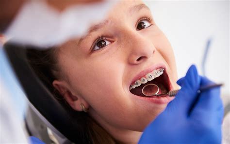Understanding The Different Types Of Orthodontic Braces