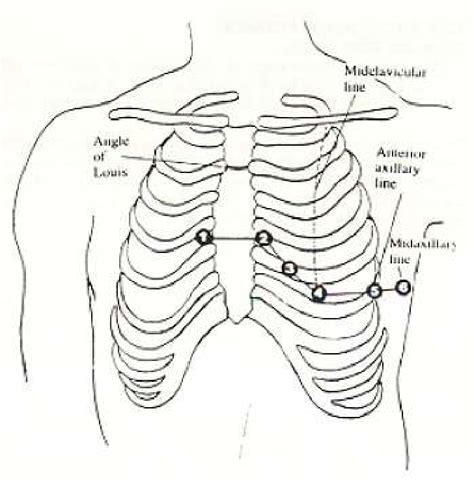 Table 1 From Resting 12 Lead Ecg Electrode Placement And