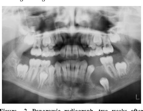 Figure 2 From Conservative Management Of A Dentigerous Cyst Associated