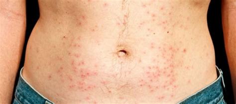 Chlorine Rash Allergy Pictures Treatment Home Remedies Prevention