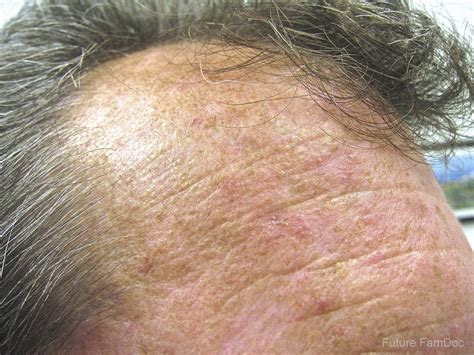 Actinic Keratosis — Gateway Dermatology