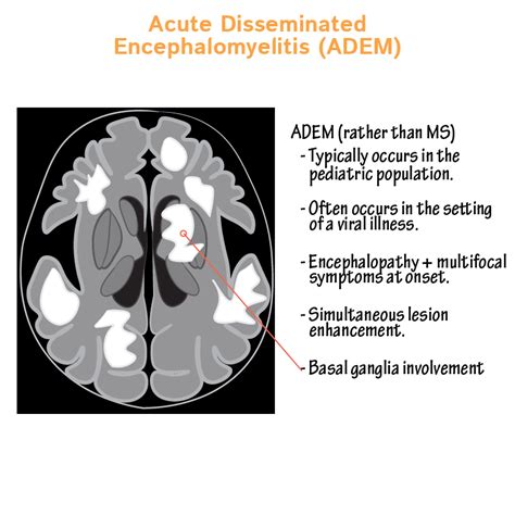 Clinical Pathology Glossary Acute Disseminated Encephalomyelitis Adem