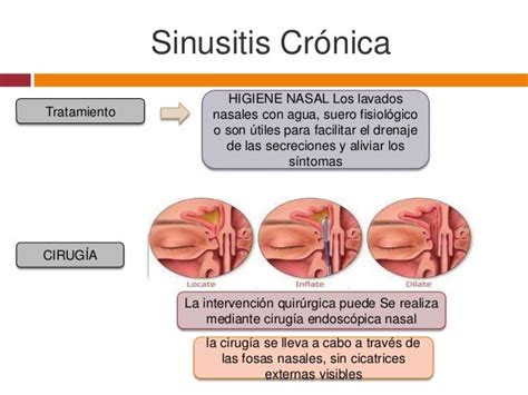 Sinusitis Cronica