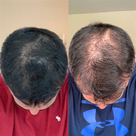 My Hair Transplant Journey Surgery Performed At The Hair Dr Leeds Uk