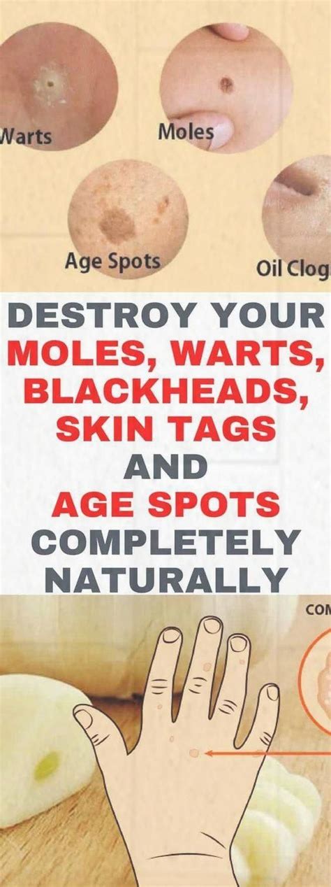 How To Get Rid Of Warts Moles Age Spots And Skin Tag Using Natural