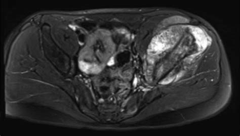 Osteosarcoma Of The Pelvis Bone And Joint