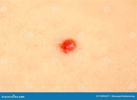 Red Spot On Skin Stock Image Image Of Shoulder Oval 74992697