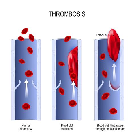 Arterial Thrombosis Vs Venous Thrombosis