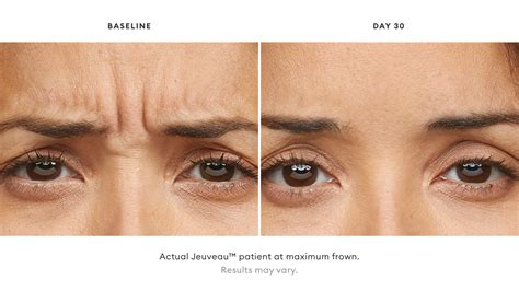 Is Jeuveau Better Than Botox Boston Jeuveau And Botox Krauss Dermatology