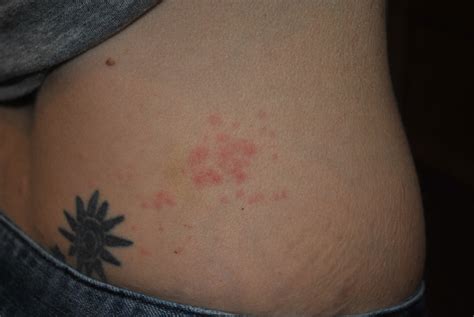 What Does Shingles Look Like What Does It Look Like Find Out Here