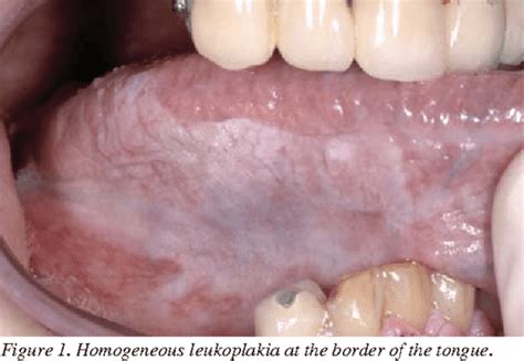 Pdf Oral Leukoplakia And Erythroplakia A Protocol For Diagnosis And
