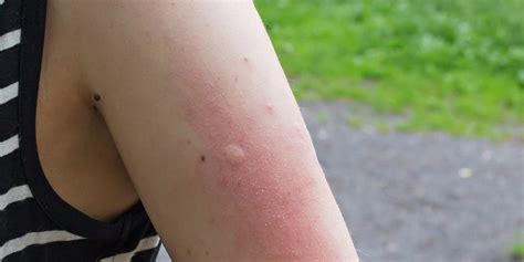 Mosquito Bite Allergy Symptoms Mosquito Bite Reaction Meaning Lupon