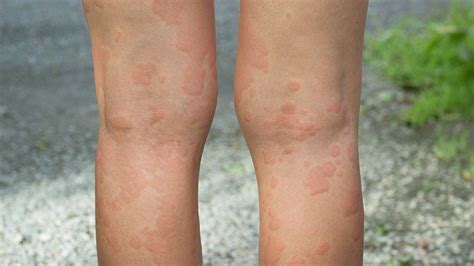 Chronic Hives Symptoms Treatments Complications