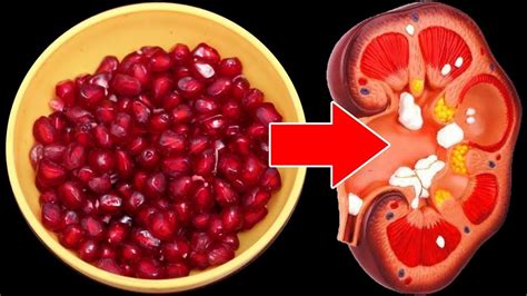 How To Pass Kidney Stones Within 2 Days Say Goodbye To Kidney Stones